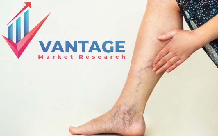 Top Companies in Varicose Veins Treatment Market | Major Players of Industry In-depth Analysis, Market insights, Competitive Analysis, | Vantage Market Research