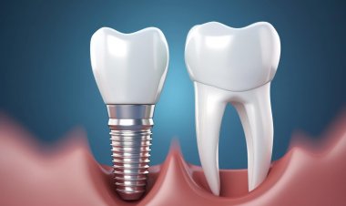 Global Dental Implants Market Size to Reach $97.7 Billion at a CAGR of 6.1% by 2030