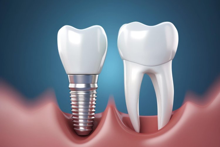 Global Dental Implants Market Size to Reach $97.7 Billion at a CAGR of 6.1% by 2030