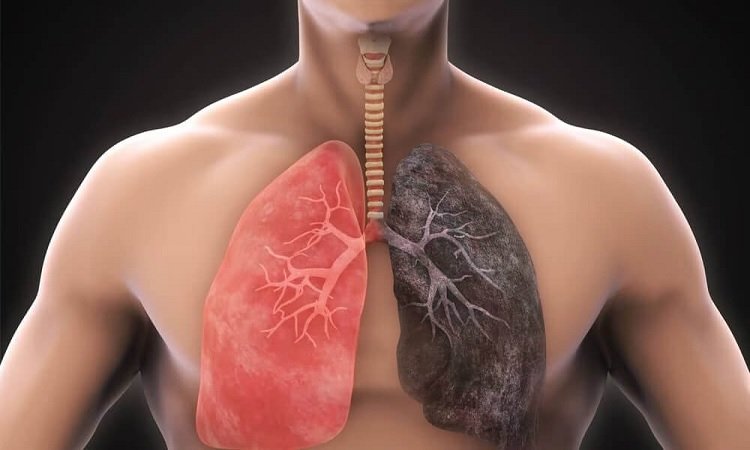 Global Chronic Obstructive Pulmonary Disease (COPD) Treatment Market Size, Share, Report 2032