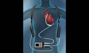 Heart Pump Device Market Size, Analytical Overview, Growth Factors, Demand and Trends Forecast to 2032