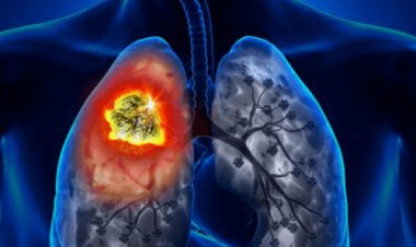 Increasing Demand In Lung Cancer Surgery Market is Booming Worldwide Growth Prospects, Incredible Demand and Business Strategies 2024-2032