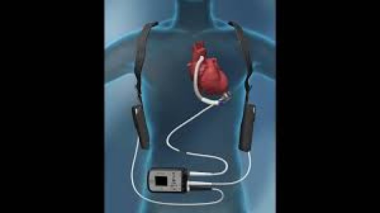 Heart Pump Device Market Size, Analytical Overview, Growth Factors, Demand and Trends Forecast to 2032