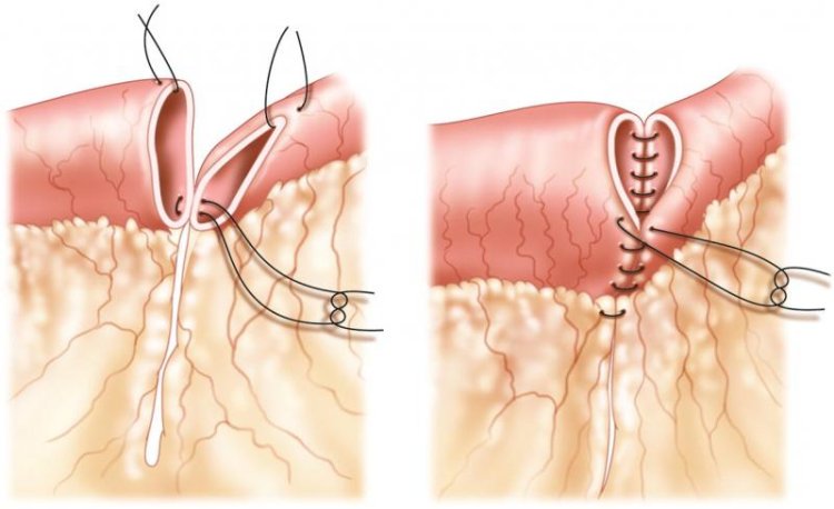 Anastomosis Device Market Size Insights and Future Growth Trends: 2024-2032