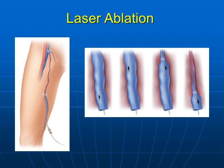 Ablation Laser Systems Market Size Insights and Future Growth Trends: 2024-2032