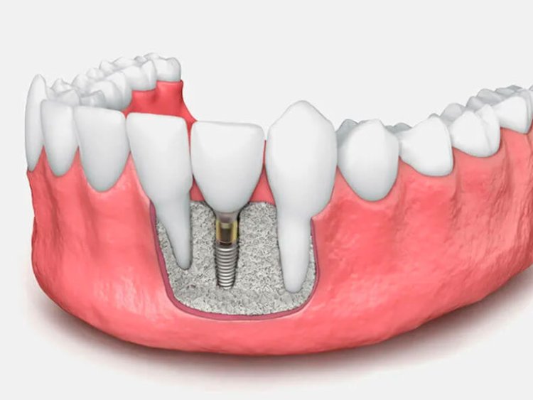 Dental Bone Graft Substitute Market 2024: Analysis by Current Insights, Future Dynamics and Innovative Strategies by 2032