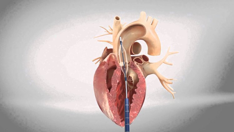 Transcatheter Aortic Valve Replacement (TAVR) Market Size, Analytical Overview, Growth Factors, Demand and Trends Forecast to 2032