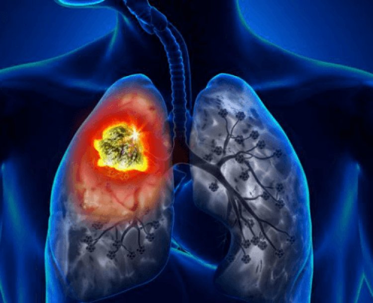 Increasing Demand In Lung Cancer Surgery Market is Booming Worldwide Growth Prospects, Incredible Demand and Business Strategies 2024-2032