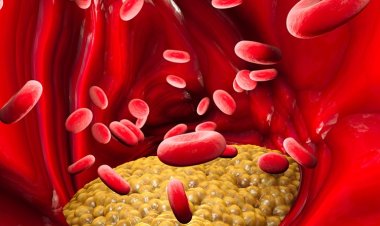 Breakthroughs in Familial Chylomicronemia Syndrome Treatments | FCS Therapy Innovations