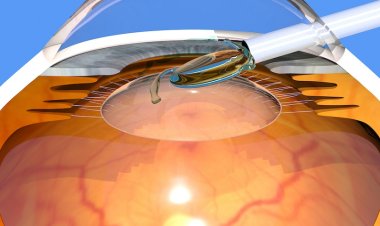 Emerging Trends in the Intraocular Lens (IOL) Industry: Innovations Shaping Vision Care