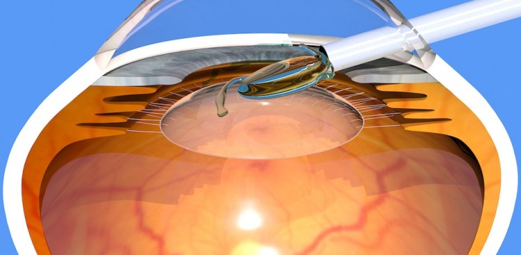 Emerging Trends in the Intraocular Lens (IOL) Industry: Innovations Shaping Vision Care