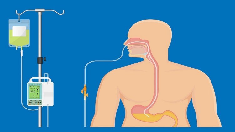 Top Trends Shaping the Enteral Feeding Devices Market in 2025