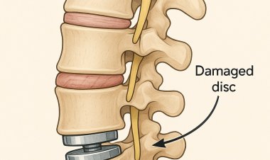 Artificial Disc Replacement Market 2025: Growth Trends, Key Players & Future Innovations