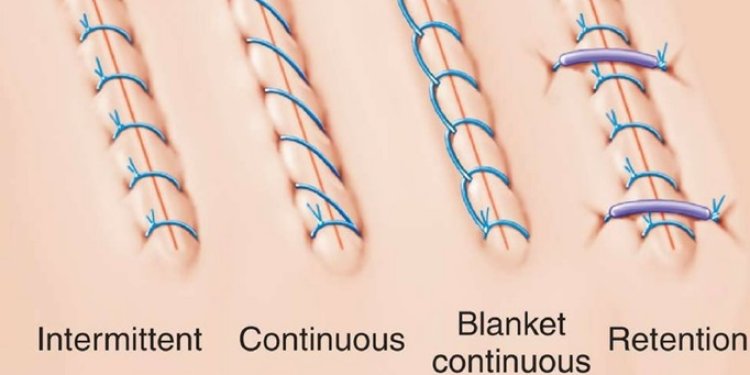 Surgical Sutures Market Size, Share & Trends Analysis Report 2025–2035